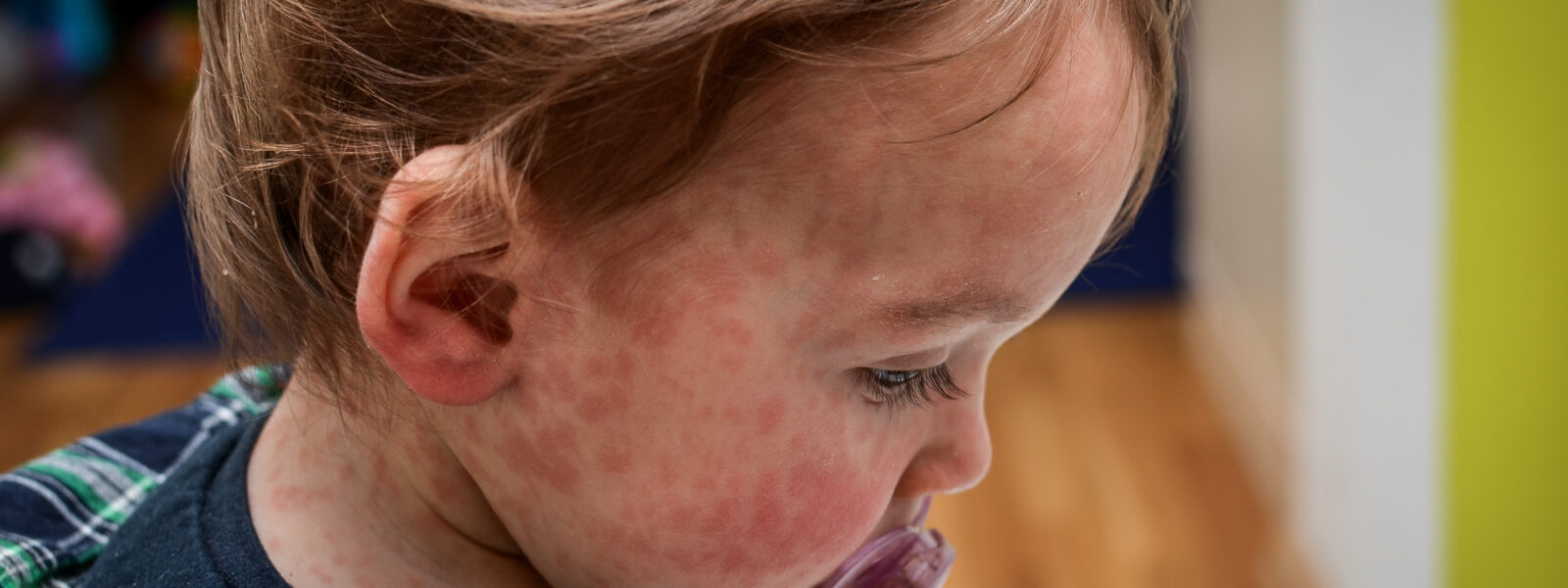 Red rash splotches covering face and neck of a toddler with a pacifier